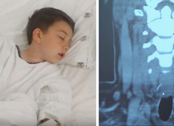 הילד הזה סבל מכאב נוראי בבטן אחרי שאכל המבורגר – בבית החולים הם גילו את הסיבה המזעזעת