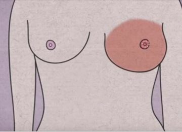 הגוף שלכן מזהיר אתכן לפני סרטן השד: 5 סימני אזהרה שאסור להתעלם מהם
