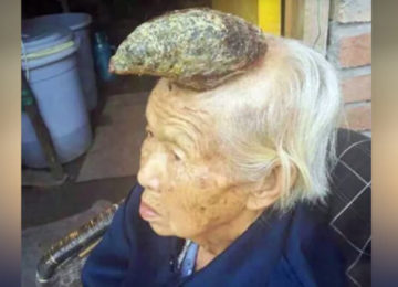 קרן גדלה על ראשה של אישה סינית בת 87. הרופאים מעולם לא ראו דבר כזה