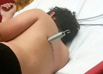 ילד בן 12 שרד לאחר שקפיץ של טרמפולינה ניקב לו את הגב: "עף כמו כדור של אקדח"