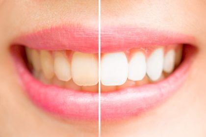 הלבינו את השיניים שלכם בבית בצורה טבעית תוך 3 דקות בלבד! יעיל ב 100%!