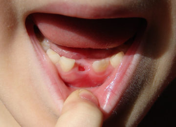 רופאים מזהירים הורים: אל תזרקו את שיני החלב של הילדים שלכם