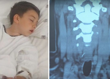 ילד סבל מכאב חד בגרון – ואז הרופאים היו בשוק ממה שהם ראו בצילום הרנטגן