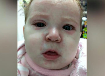 התינוקת הזו נדבקה בחצבת בגלל מתנגדי חיסונים