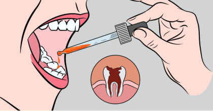 שימו כמה טיפות של התרופה הטבעית הזו בפה, והיפטרו בשניות מכאבי השיניים